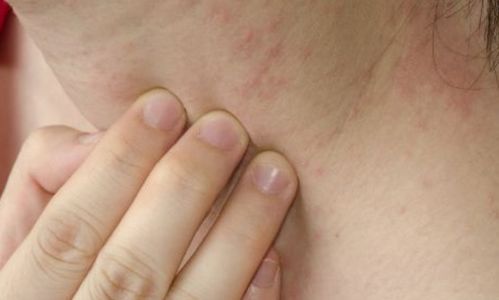 怎么避免灰指甲的加重 怎么避免灰指甲的加重