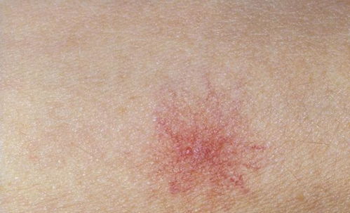 沈阳快速治疗尖锐湿疹方法有哪些 沈阳快速治疗尖锐湿疹方法有哪些