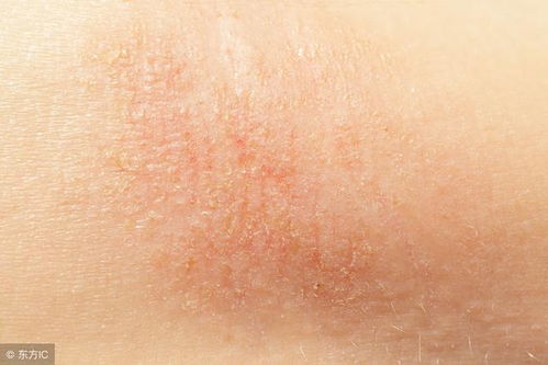 宝宝过敏性荨麻疹能吃葡萄 宝宝过敏性荨麻疹能吃葡萄