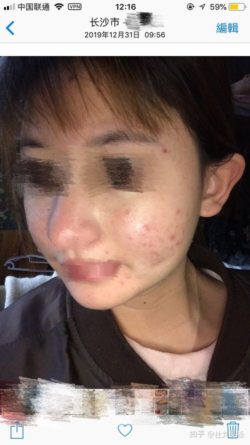 上下班挤地铁也能挤出荨麻疹 上下班挤地铁也能挤出荨麻疹