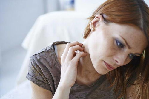 该如何治疗牛皮癣 该如何治疗牛皮癣