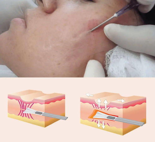 感染艾滋病23月有什么症状 感染艾滋病23月有什么症状