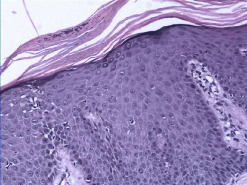 小儿荨麻疹发病的特点 小儿荨麻疹发病的特点