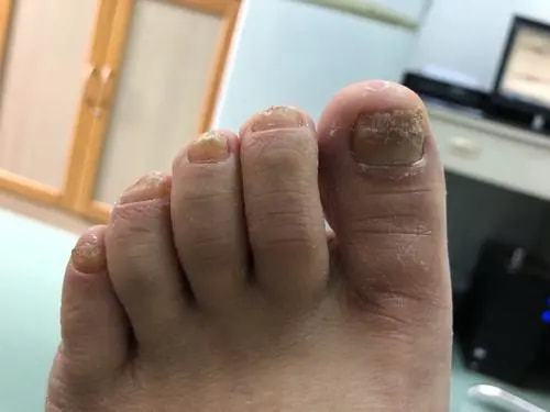 季节更换与免疫异常可致牛皮癣 季节更换与免疫异常可致牛皮癣