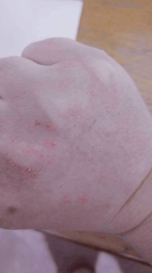 治疗脚气的医院排名 治疗脚气的医院排名