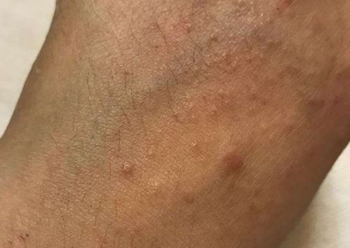 脚气的泡泡水能挤完么 脚气的泡泡水能挤完么