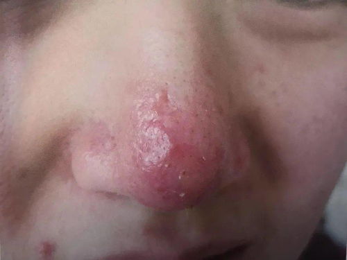 花椒水可以治脚臭和脚气吗 花椒水可以治脚臭和脚气吗