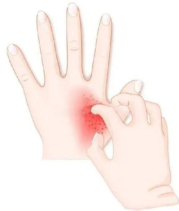 灰指甲的诱因有什么 灰指甲的诱因有什么