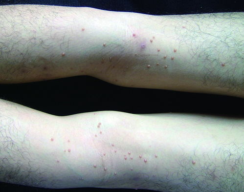 成年人预防湿疹 要摆脱这些坏习惯 成年人预防湿疹 要摆脱这些坏习惯