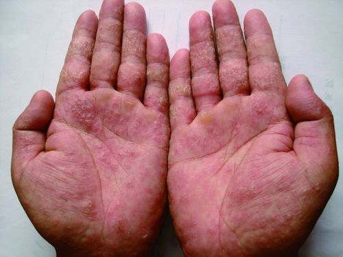 灰指甲的传播途径有哪些呢 灰指甲的传播途径有哪些呢