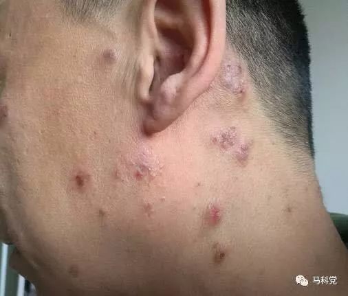 脚趾缝之间脱皮是脚气么 脚趾缝之间脱皮是脚气么