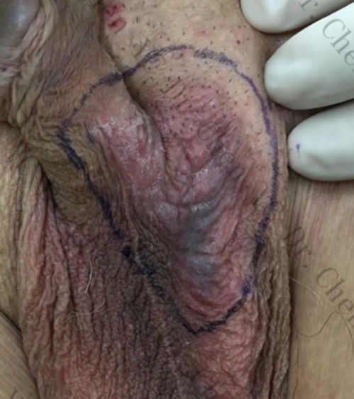 灰指甲会哪些并发症 灰指甲会哪些并发症