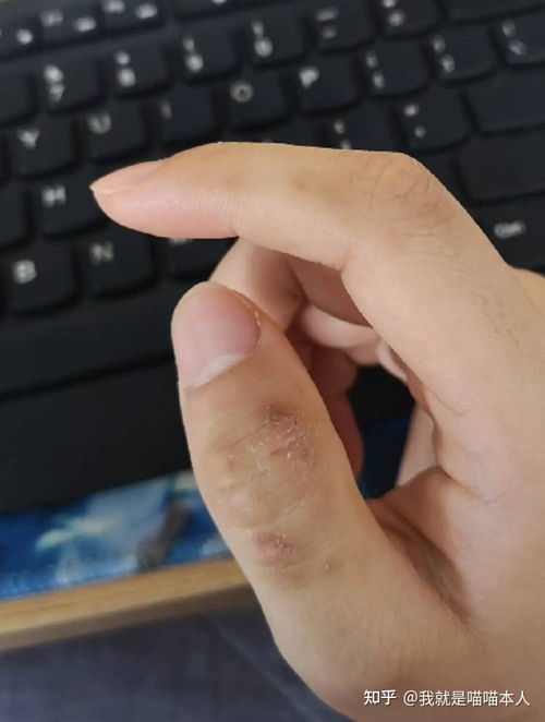 有脚气的话用什么水泡 有脚气的话用什么水泡
