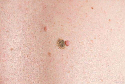 为何你的脚气反复发作 为何你的脚气反复发作