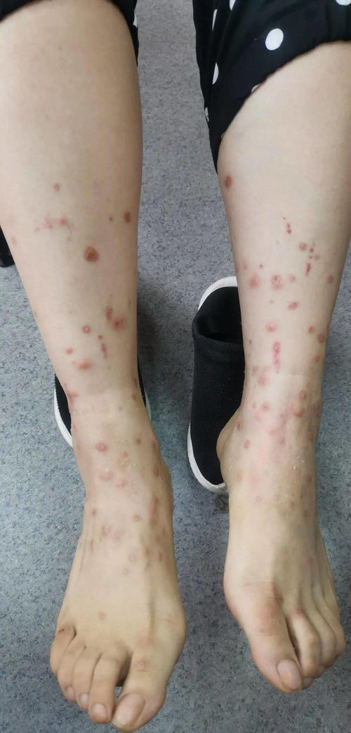 白醋和白糖泡脚治脚气 白醋和白糖泡脚治脚气