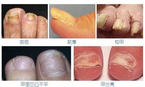 寻常痤疮诊断要点简介 寻常痤疮诊断要点简介