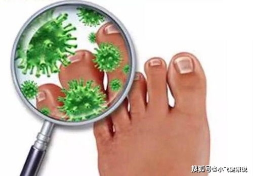 怎么治脚气沙 脚气沙虫怎么治能除根 怎么治脚气沙 脚气沙虫怎么治能除根