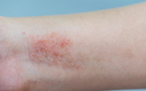 北京皮肤病医院排名 痤疮是一种什么样的疾病 北京皮肤病医院排名 痤疮是一种什么样的疾病