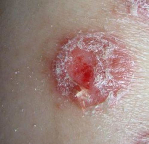 ����Ƥ��ˮ�ݽ��ν�����
