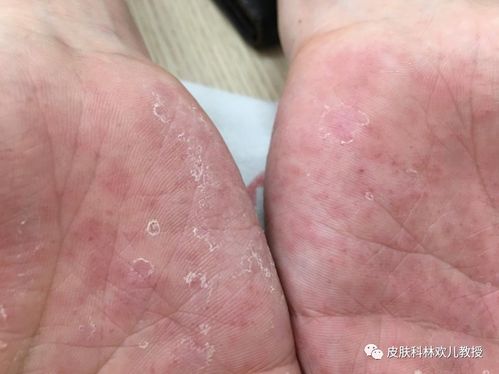 脚气高度醋 脚气用几度醋泡脚 脚气高度醋 脚气用几度醋泡脚