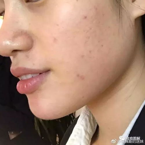 治脚气好一点的药有哪些 治脚气好一点的药有哪些