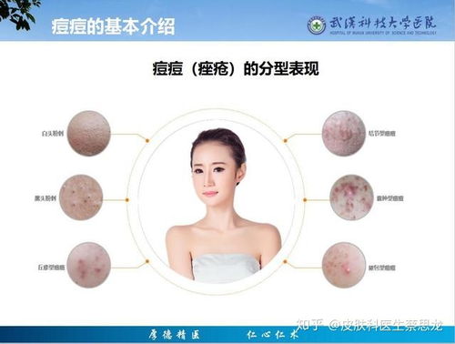 盐酸左氧氟沙星胶囊脚气 盐酸左氧氟沙星胶囊脚气