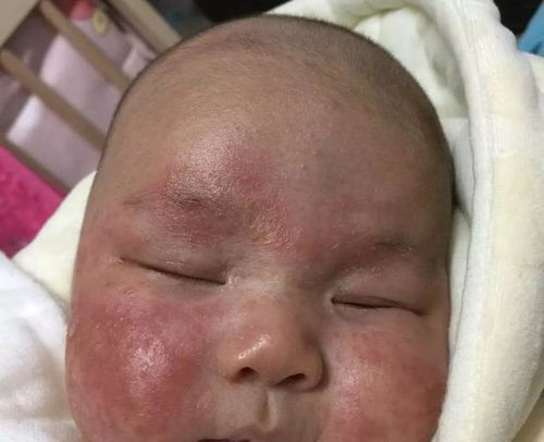 额头长痤疮的病因是什么 额头长痤疮的病因是什么