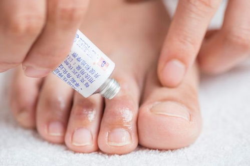 荨麻疹型药疹应如何预防 荨麻疹型药疹应如何预防