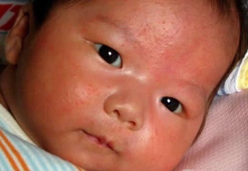 牛皮癣较初是什么症状 牛皮癣较初是什么症状