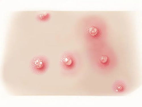 脚湿疹是什么 脚湿疹是什么