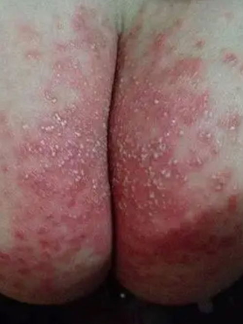 脚气脱皮医生怎么处理 脚气脱皮医生怎么处理