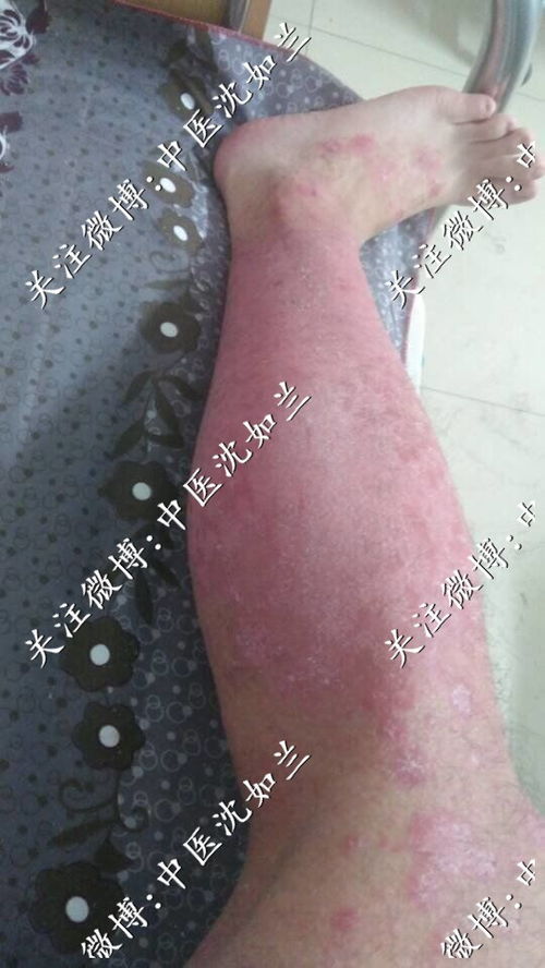 共同一个梯子室友有脚气 共同一个梯子室友有脚气