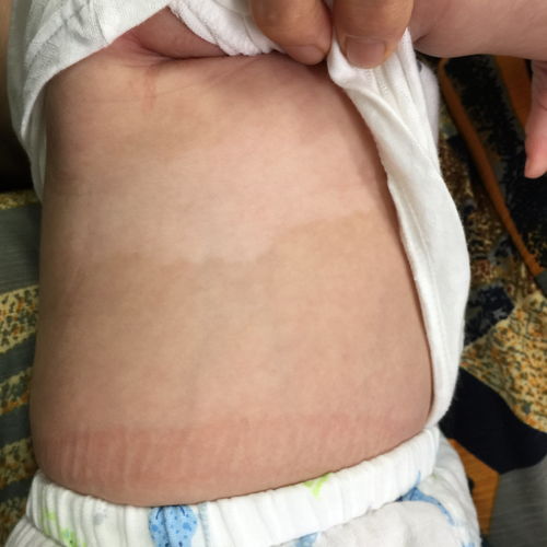 脚气可分为几种类型 脚气可分为几种类型