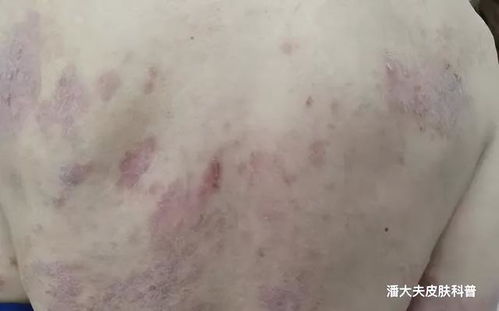 脚气烂脚可以用炉甘石吗 脚气烂脚可以用炉甘石吗