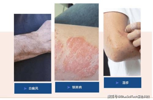 999皮炎平可以治脚气 999皮炎平可以治脚气