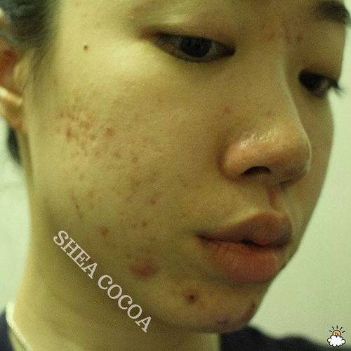 酮康唑软膏治什么脚气 酮康唑软膏治什么脚气