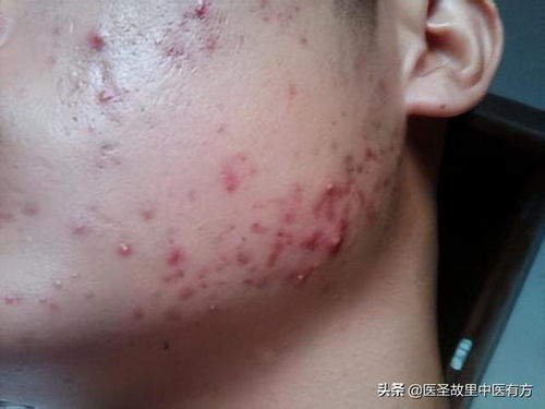 脚气严重脚破了 脚气破了皮有没有好办法治疗 脚气严重脚破了 脚气破了皮有没有好办法治疗