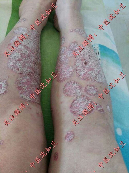 孕妇患脚气能用脚气药吗 孕妇患脚气能用脚气药吗