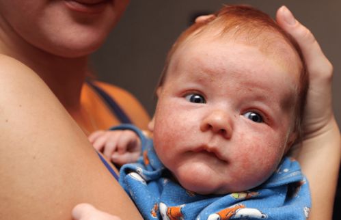 灰指甲会什么症状 灰指甲会什么症状