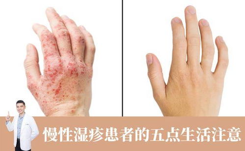 可乐和盐可以治疗脚气吗 可乐和盐可以治疗脚气吗