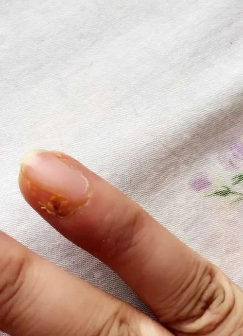 脚气属于什么细菌 脚气属于什么细菌类型 脚气属于什么细菌 脚气属于什么细菌类型