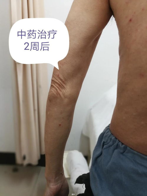 出脓的脚气属于什么脚气 出脓的脚气属于什么脚气