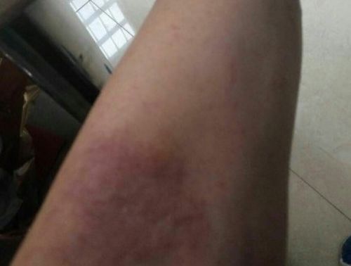 灰指甲有哪些症状 灰指甲有哪些症状