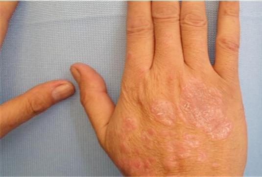 景德镇哪家治疗牛皮癣好 利于治疗牛皮癣的三种食疗方 景德镇哪家治疗牛皮癣好 利于治疗牛皮癣的三种食疗方