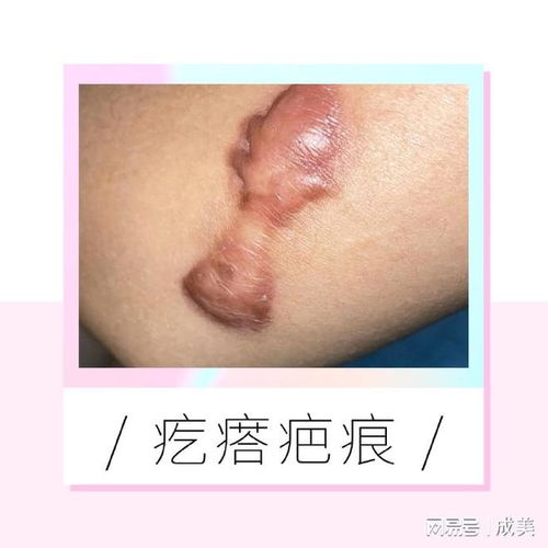 怀孕了有脚气影响胎儿吗 怀孕了有脚气影响胎儿吗