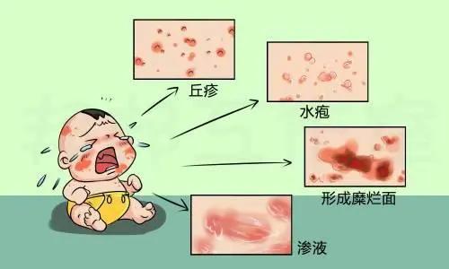 为什么脚气好了又痒脚气突然好了可是皮肤痒了 为什么脚气好了又痒脚气突然好了可是皮肤痒了