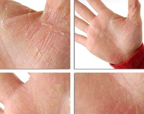 脚气反复发作难治愈 那就试试这些方法 脚气反复发作难治愈 那就试试这些方法