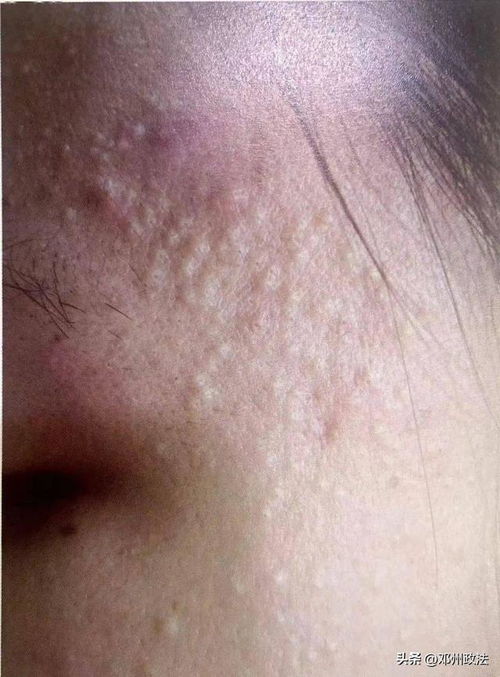 脚气的主要护理措施 脚气的主要护理措施