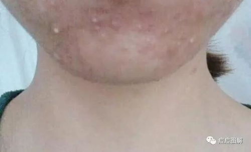 不穿靴子没脚气(穿没有脚气的人的鞋会得脚气吗) 不穿靴子没脚气(穿没有脚气的人的鞋会得脚气吗)