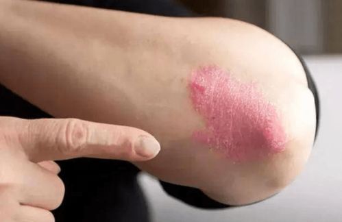 肾结石肚子疼怎么办 肾结石肚子疼怎么办